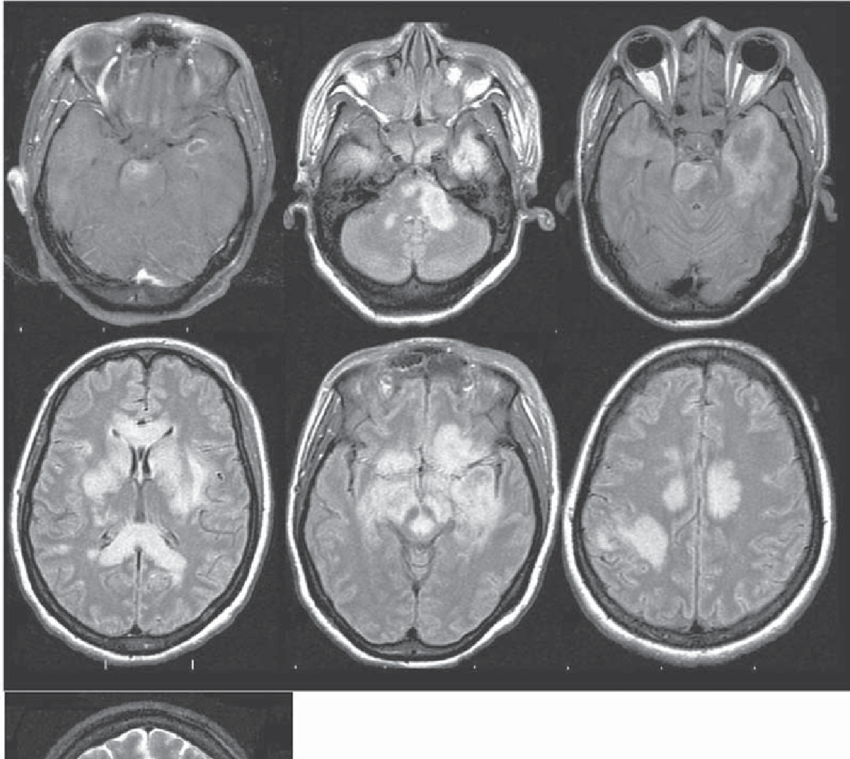 Sete pequenas imagens de lâminas cerebrais feitas a partir de uma ressonância magnética, dispostas em três linhas e duas colunas. As lâminas destacam manchas brancas no cérebro.